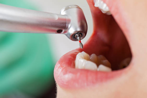Best Knocked-Out Tooth (Avulsed Tooth) Treatment in Clayton, GA